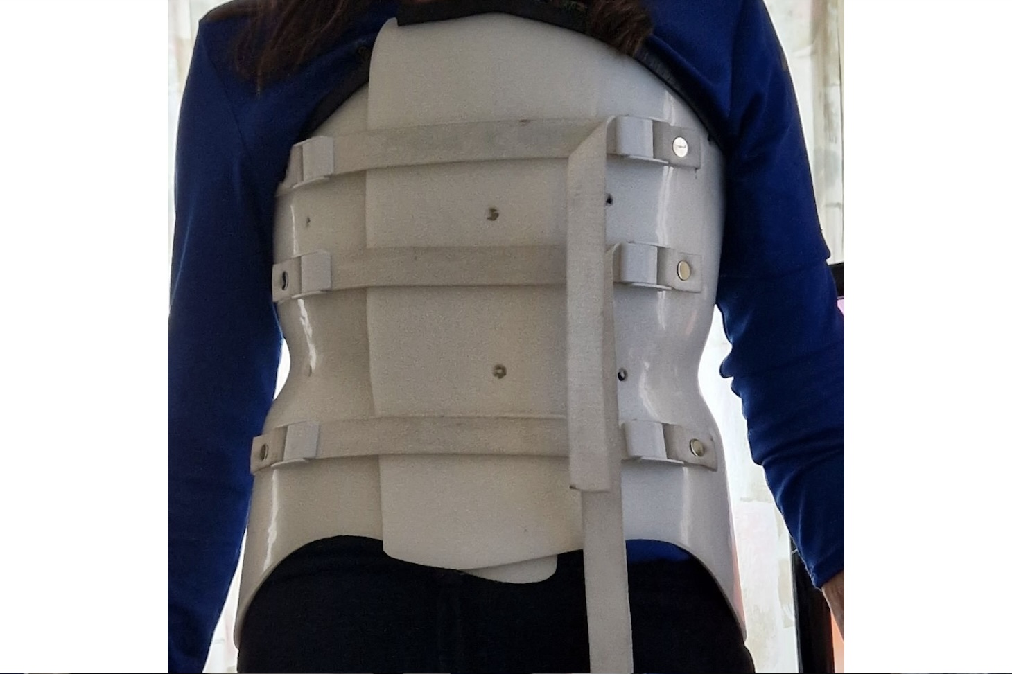 Efter att Marianne brutit ryggen fick hon bära korsett under fem månader.